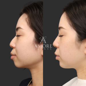 アゴ出しスレッド