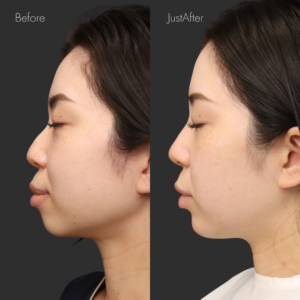 アゴ出しスレッド