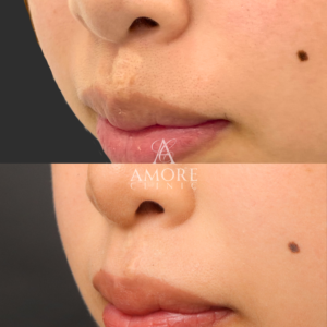 傷跡修正（切開法）