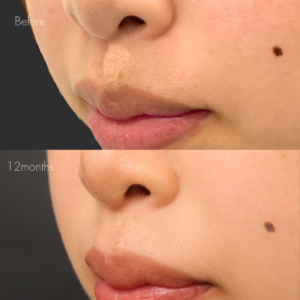 傷跡修正（切開法）