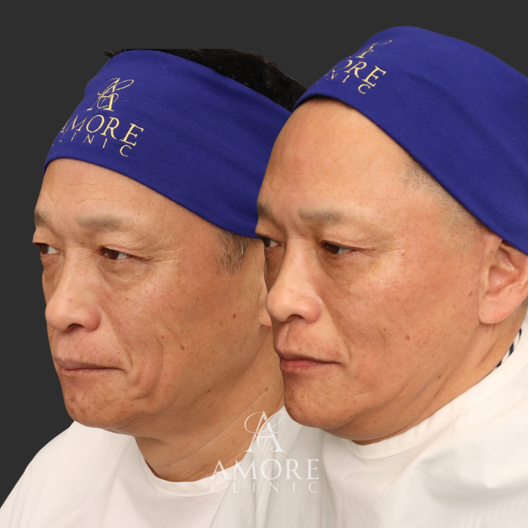 フルリフト＋ベイザー脂肪吸引（小顔セット）＋パーフェクト二重術＋下眼瞼脱脂・たるみ取り＋ジュビダーム１㏄・ボトックス（顎）