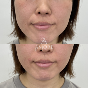 ほうれい線ヒアルロン酸（ジュビダーム1cc）