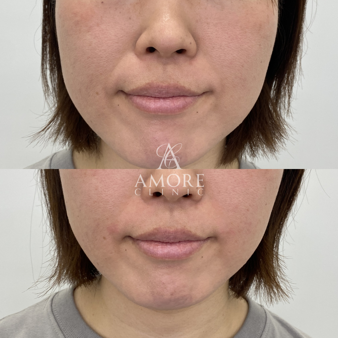 ほうれい線ヒアルロン酸（ジュビダーム1cc）