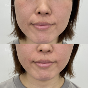 ほうれい線ヒアルロン酸（ジュビダーム1cc）