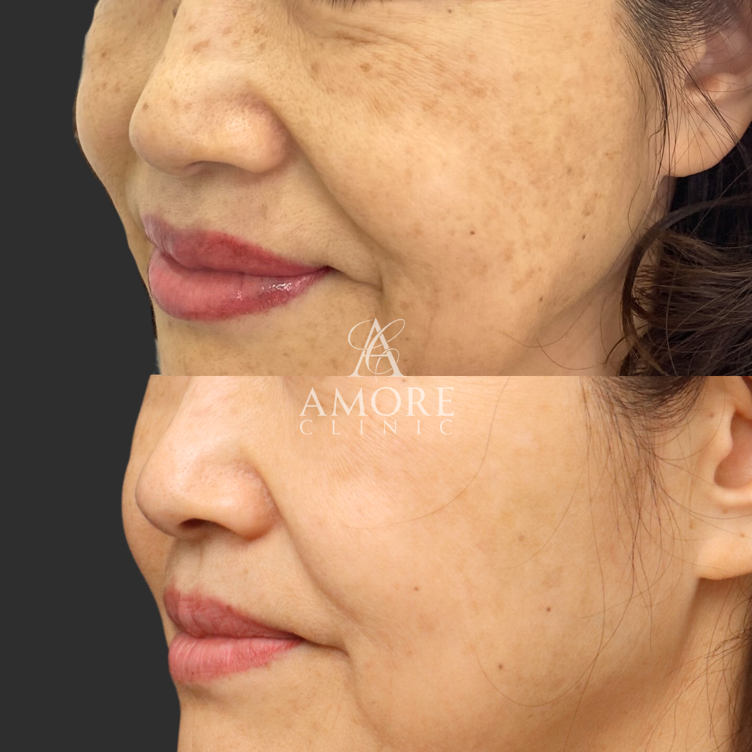 ピコトーニング＋ケアシス雪美人（5回コース）