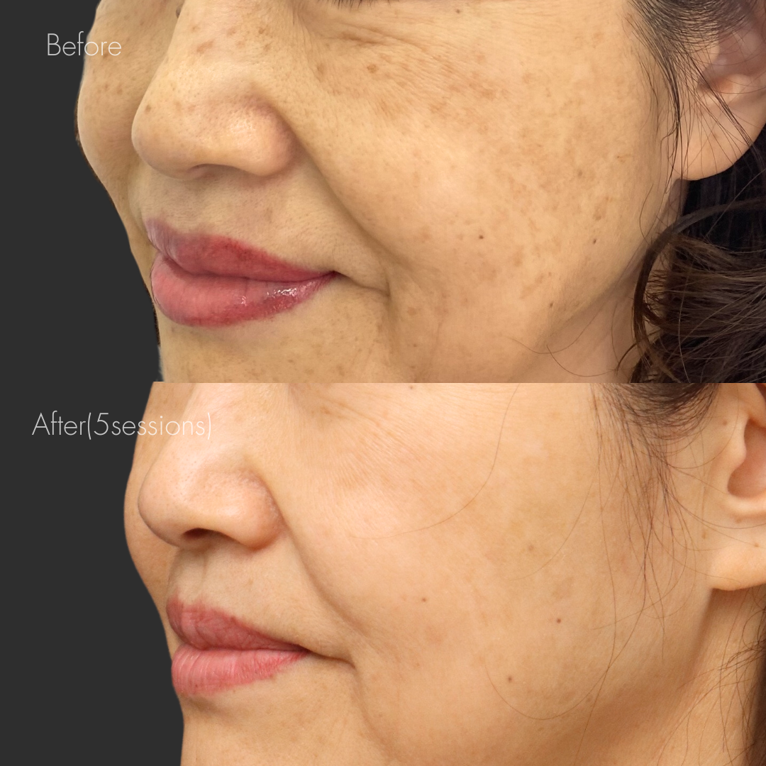 ピコトーニング＋ケアシス雪美人（5回コース）