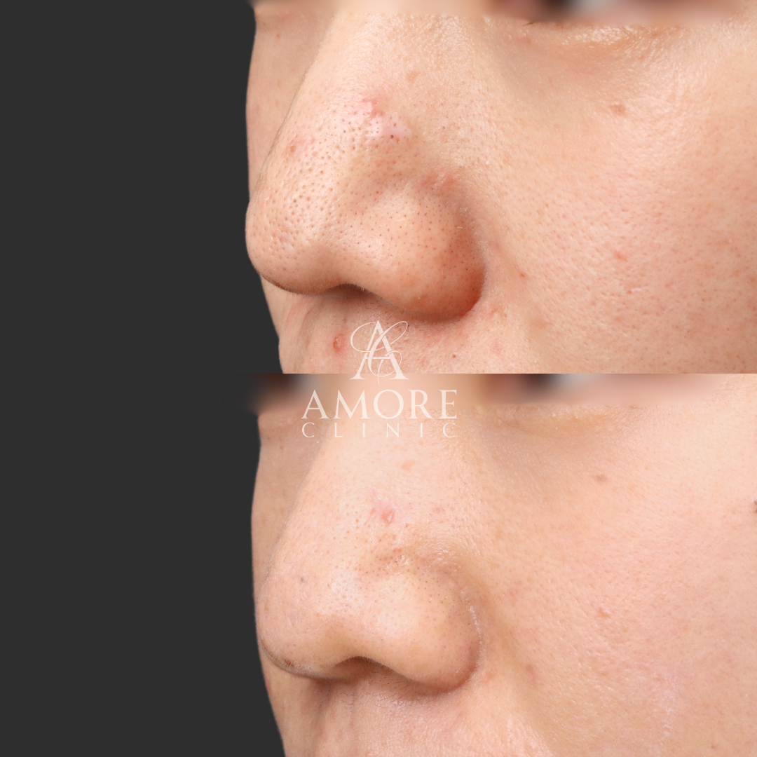 傷跡修正（切開法）