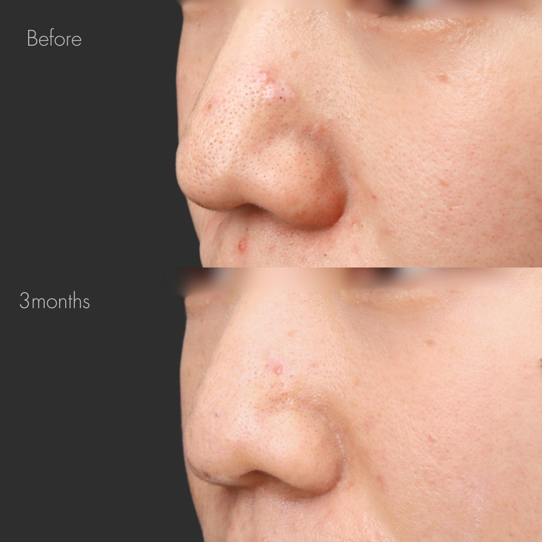 傷跡修正（切開法）