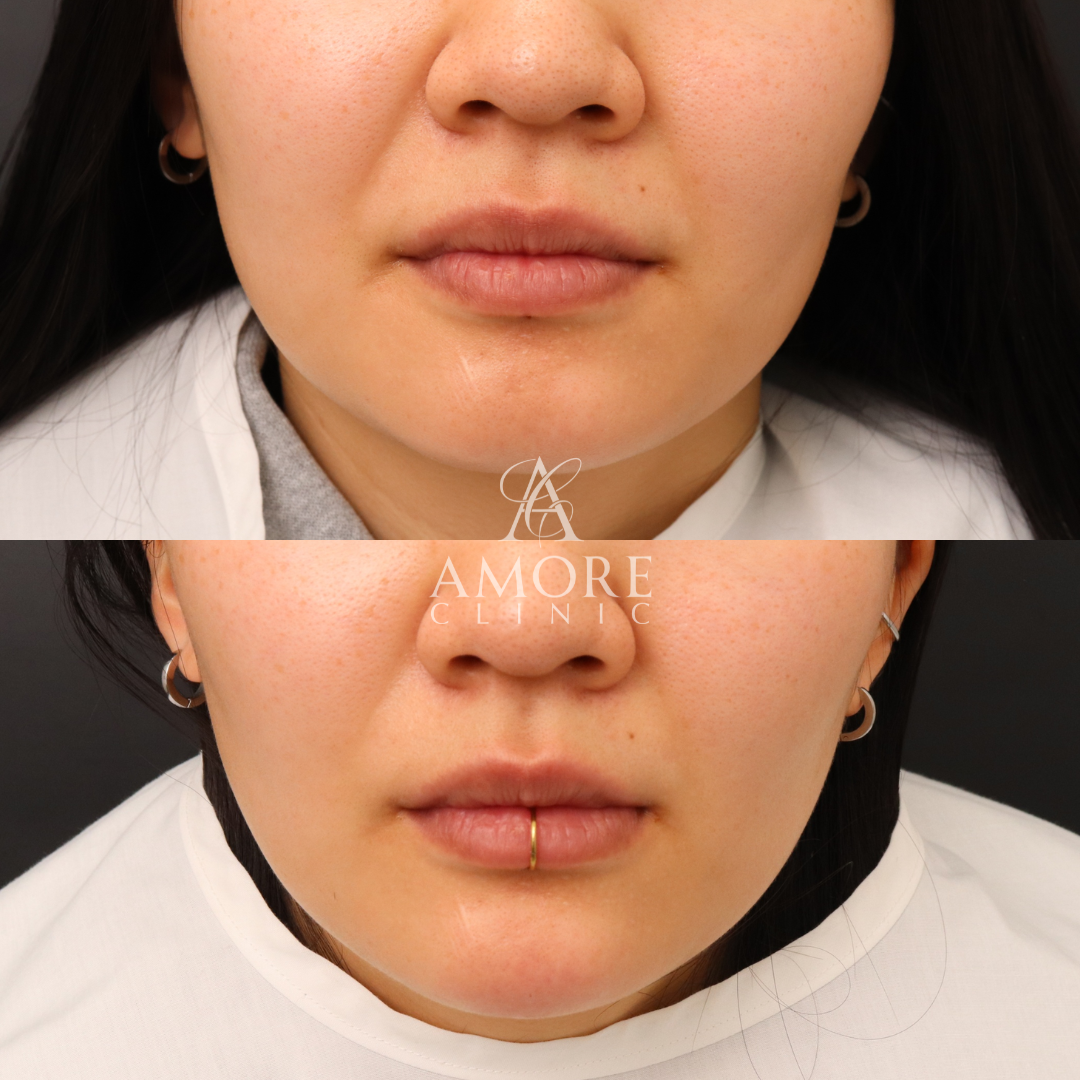 あごヒアルロン酸