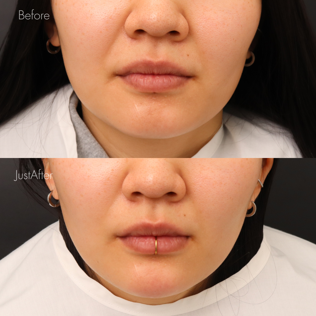 あごヒアルロン酸