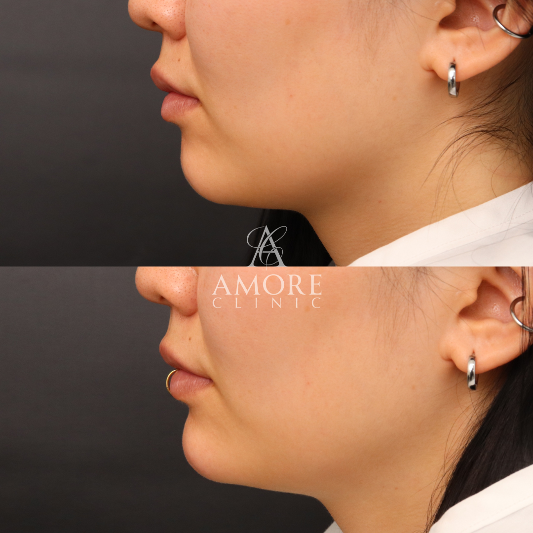 あごヒアルロン酸