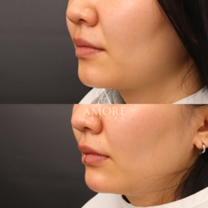 あごヒアルロン酸