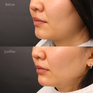 あごヒアルロン酸