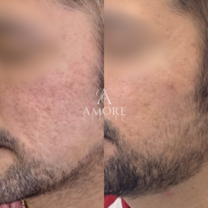 サブシジョン（両ほほ・こめかみ）