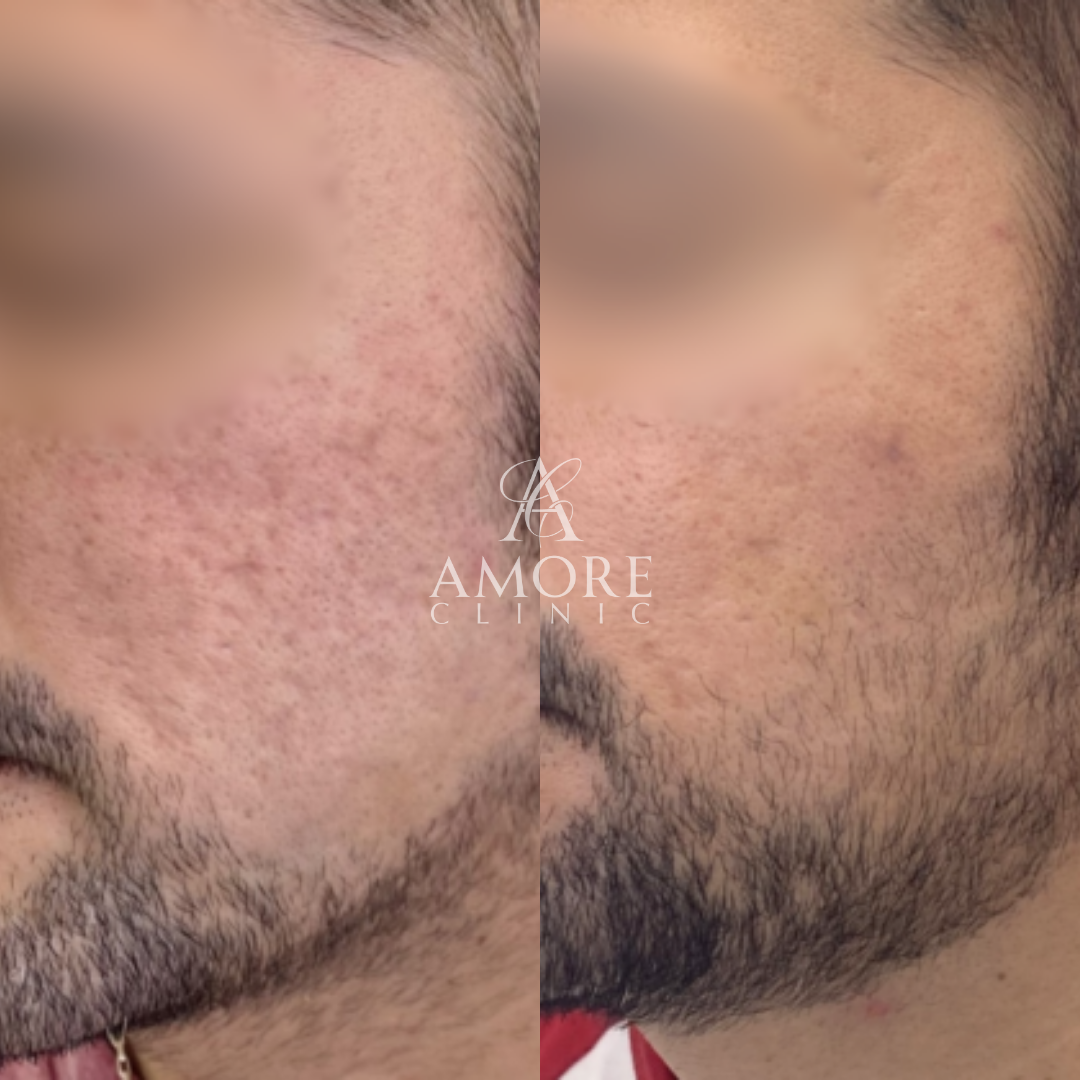 サブシジョン（両ほほ・こめかみ）