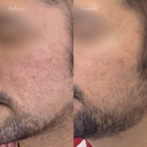 サブシジョン（両ほほ・こめかみ）