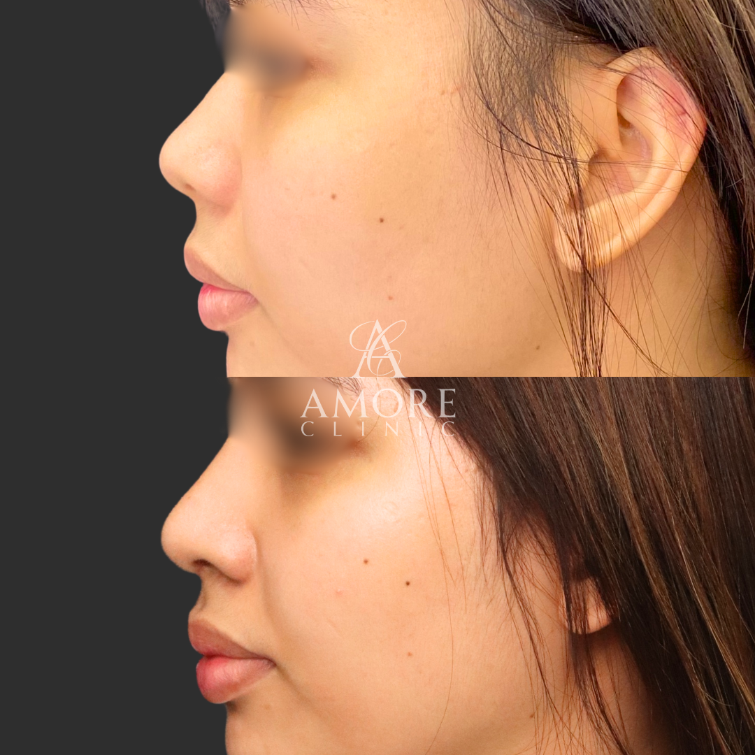 プロテーゼ挿入＋鼻尖縮小＋耳介軟骨移植