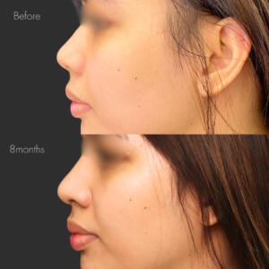 プロテーゼ挿入＋鼻尖縮小＋耳介軟骨移植