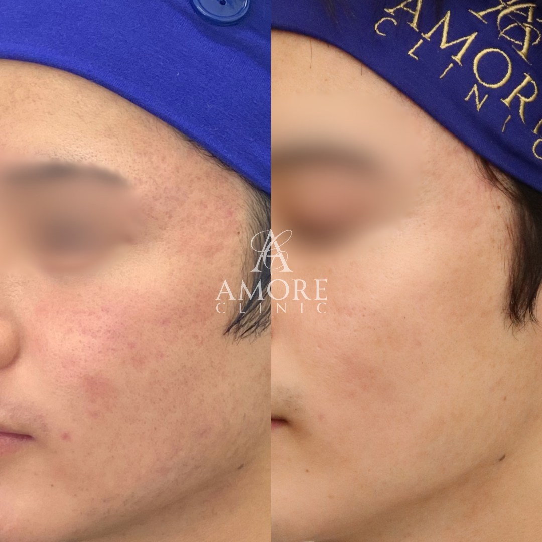 サブシジョン（両ほほ・こめかみ）