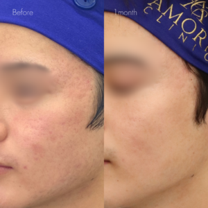 サブシジョン（両ほほ・こめかみ）