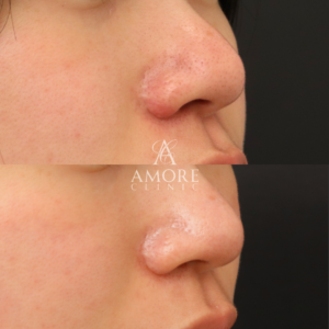 鼻翼縮小後の傷跡修正（グラデーション加工）