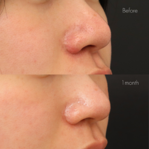 鼻翼縮小後の傷跡修正（グラデーション加工）