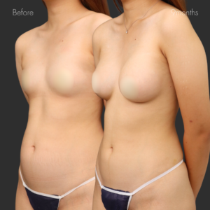 シリコンバッグ豊胸（モティバ275cc）