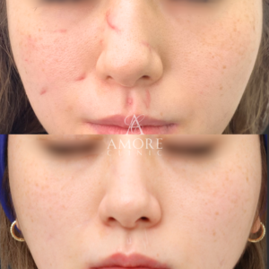 犬咬傷治療（切開法）