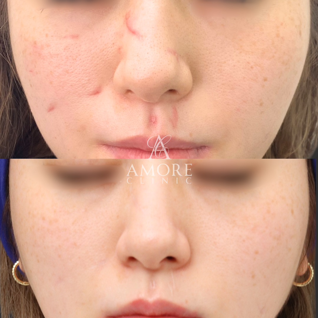 犬咬傷治療（切開法）