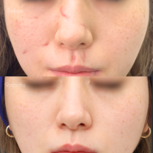 犬咬傷治療（切開法）