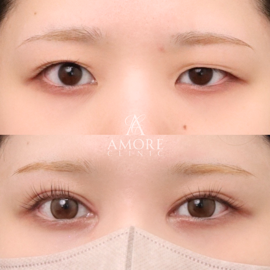 眼瞼下垂+たるみ取り+脂肪取り+埋没糸抜去+目頭切開