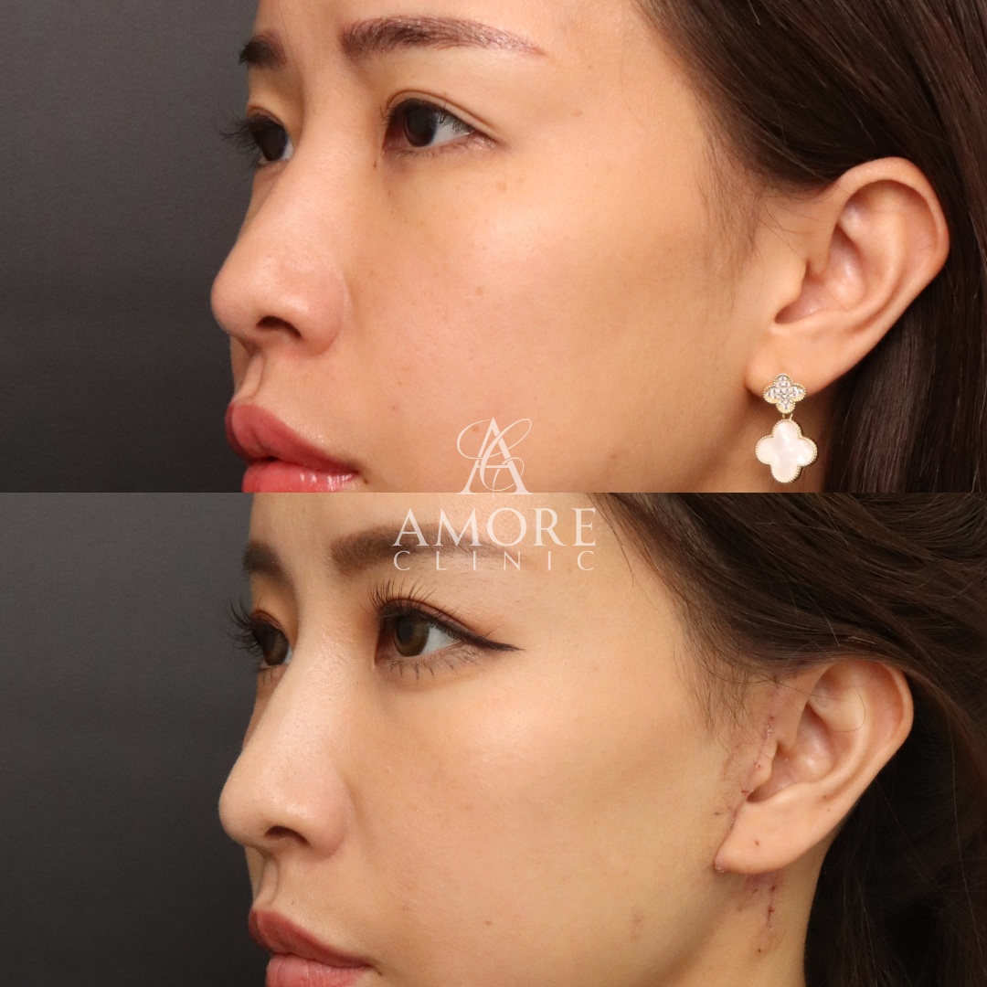 ノーズスレッド（Y-ko10本）＋ベイザー脂肪吸引（小顔セット）＋ミディアムリフト