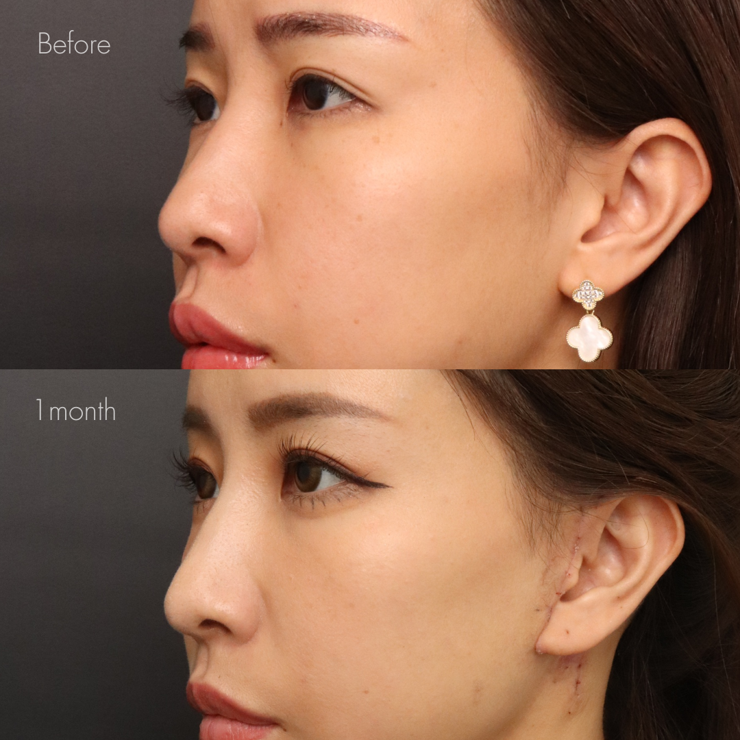 ノーズスレッド(Y-ko10本)+ベイザー脂肪吸引(小顔セット)+ミディアムリフト