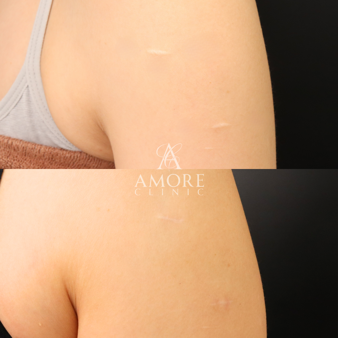 傷跡修正（切開法）