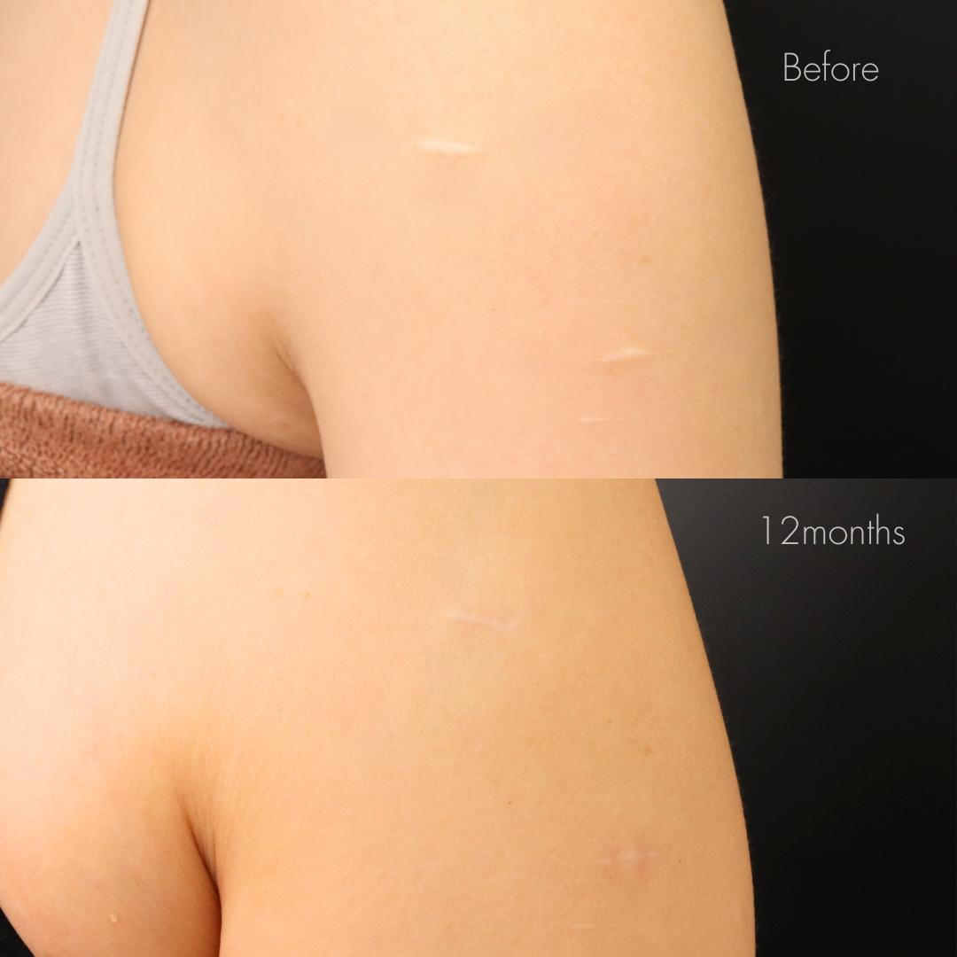 傷跡修正（切開法）