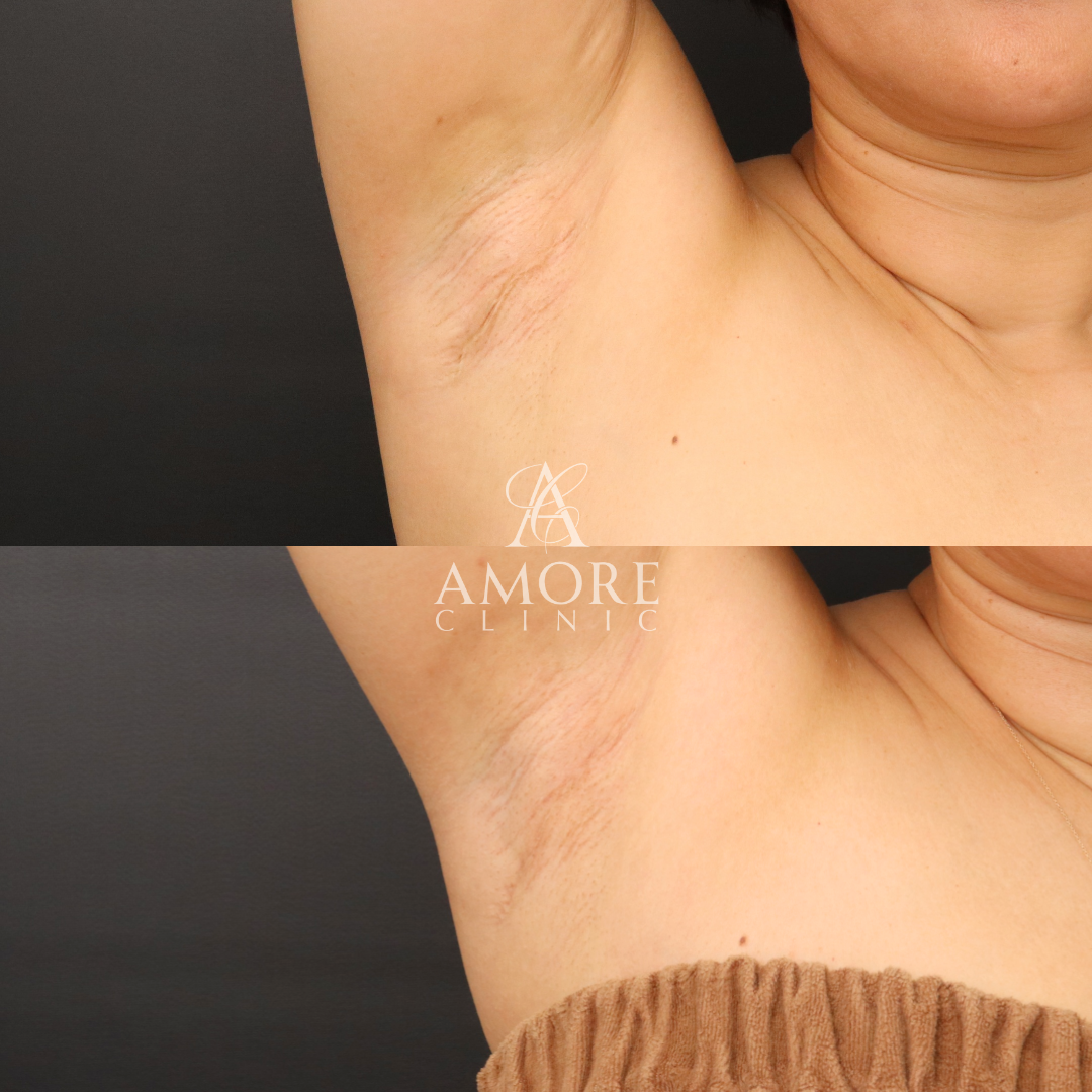 ワキガ手術後の傷跡修正（切開法）