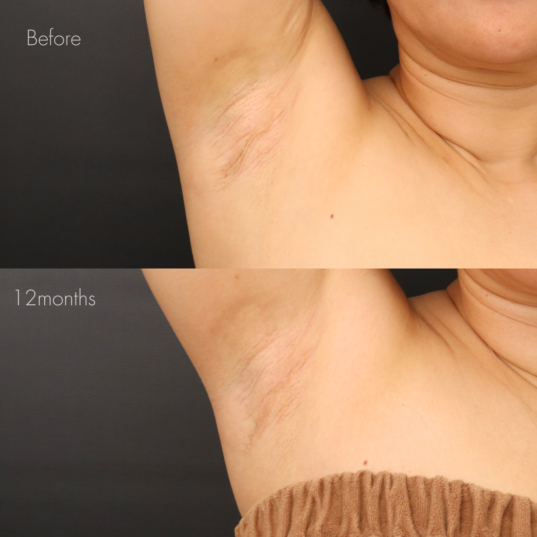 ワキガ手術後の傷跡修正（切開法）