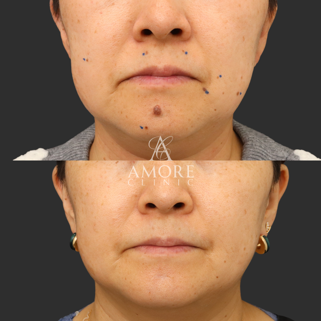 ほくろ除去・切除