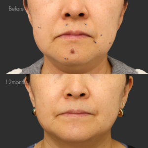 ほくろ除去・切除