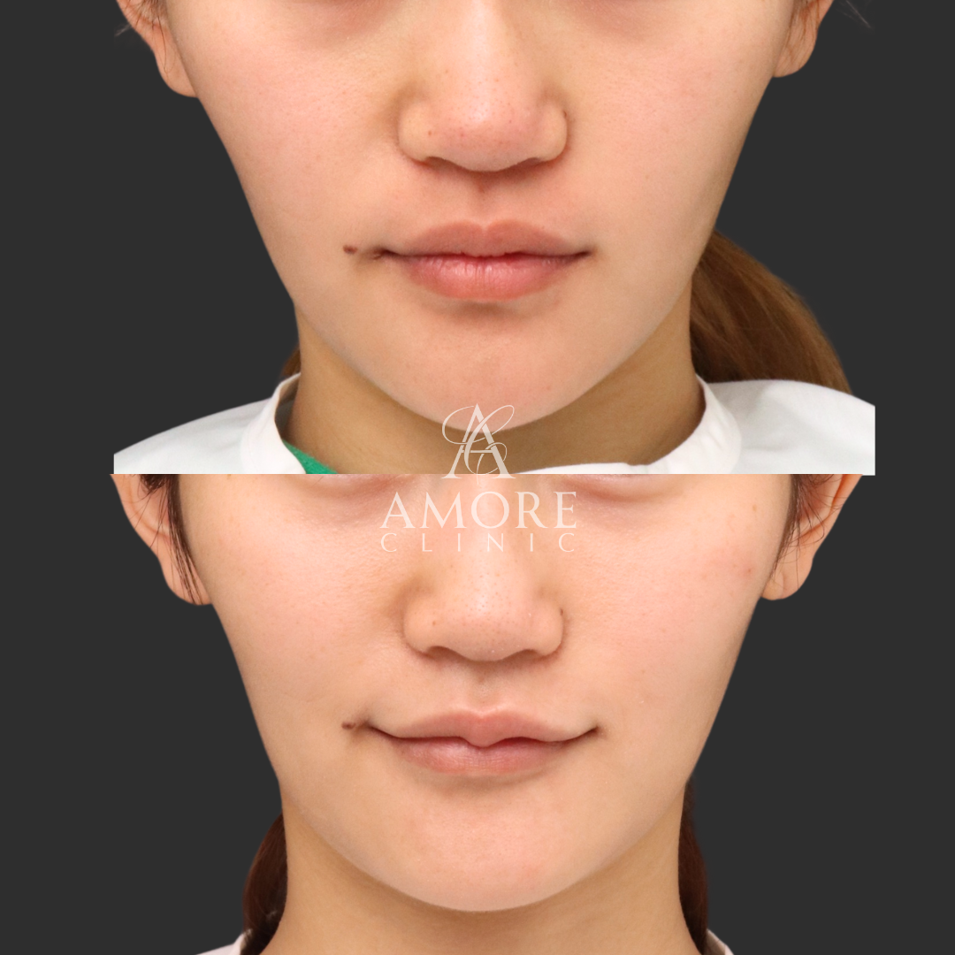 M字リップセット（唇ヒアルロン酸＋口角ボトックス）