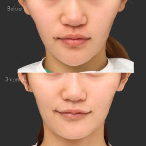 M字リップセット（唇ヒアルロン酸＋口角ボトックス）