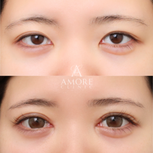 パーフェクト二重術（二重全切開＋たるみ除去＋脂肪除去）＋埋没糸抜去＋目頭切開