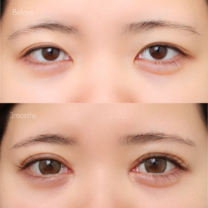 パーフェクト二重術（二重全切開＋たるみ除去＋脂肪除去）＋埋没糸抜去＋目頭切開