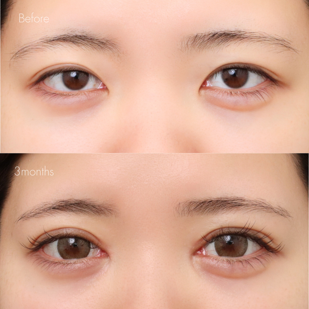 パーフェクト二重術（二重全切開＋たるみ除去＋脂肪除去）＋埋没糸抜去＋目頭切開