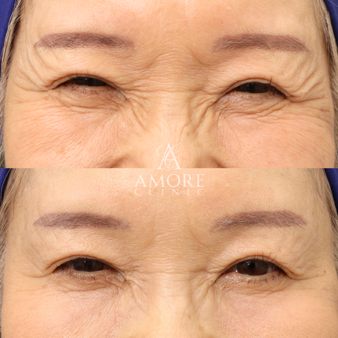 眉間ボトックス