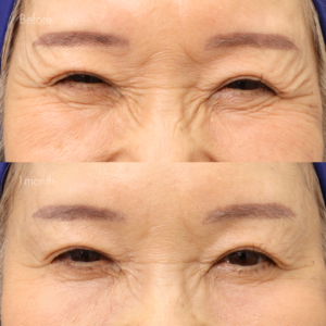 眉間ボトックス