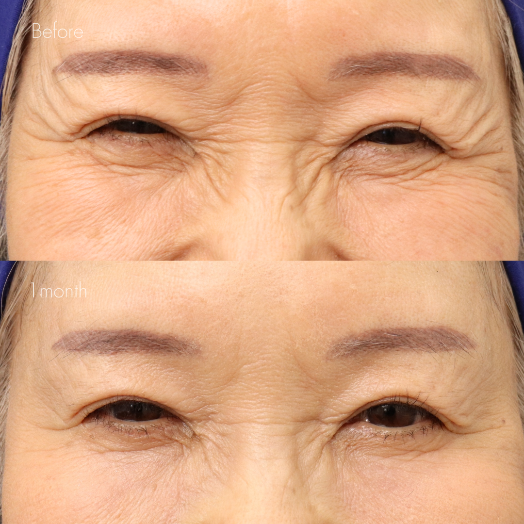 眉間ボトックス