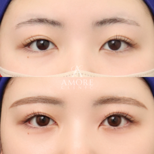 パーフェクト二重術（二重全切開＋たるみ除去＋脂肪除去）＋埋没糸抜去