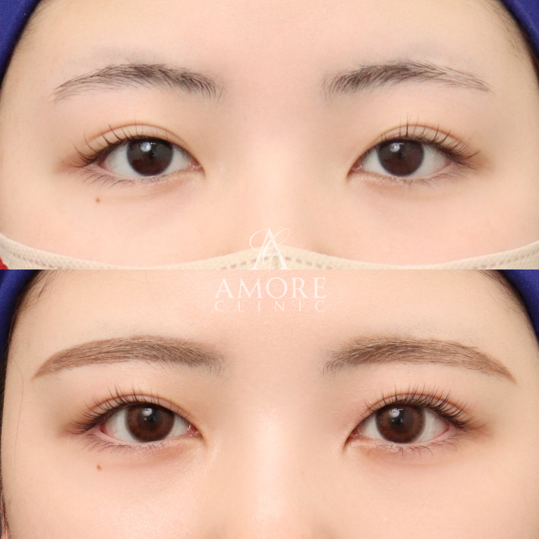 パーフェクト二重術（二重全切開＋たるみ除去＋脂肪除去）＋埋没糸抜去