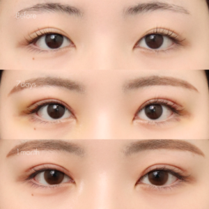 パーフェクト二重術（二重全切開＋たるみ除去＋脂肪除去）＋埋没糸抜去